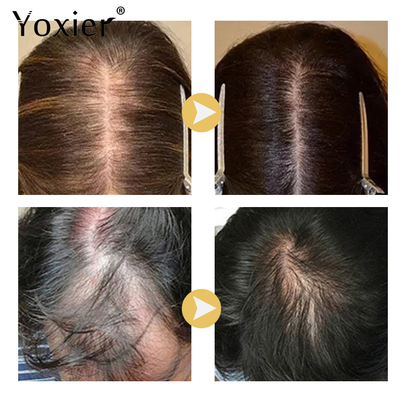 Suero de crecimiento intensivo - Hair Care For Hair Loss reseña y precio